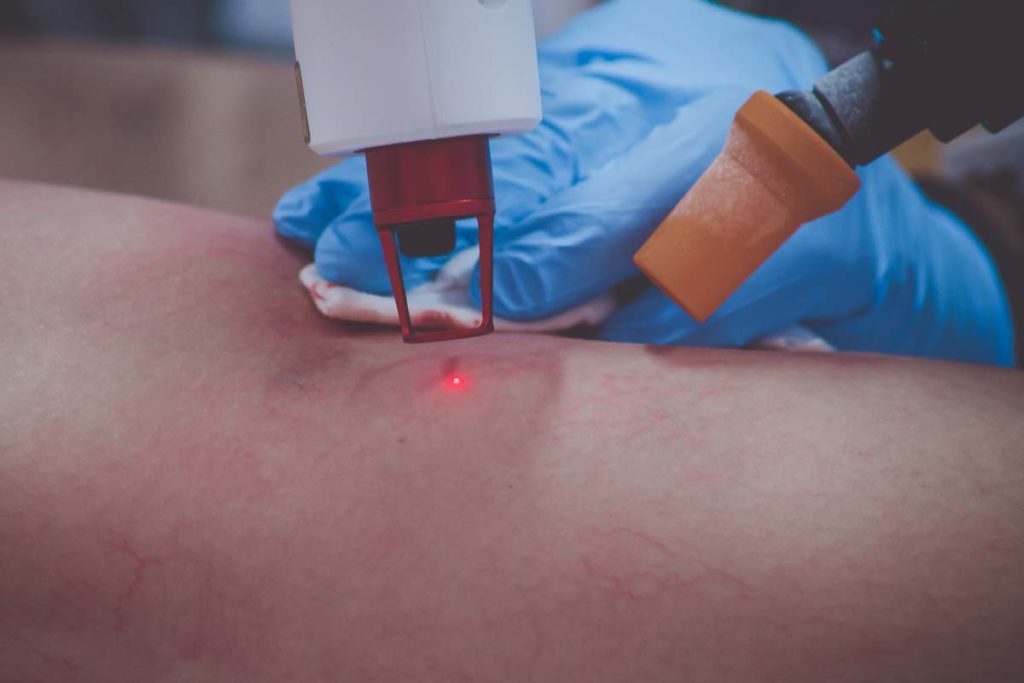 O Laser e sua utilização na Cirurgia Vascular